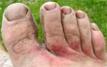 The top of each toe adjacent to the foot has rubbed raw due to days of saturation with water and friction from walking. See the blister on the inside top of the big toe, it has been drained and has reformed several times. August 4