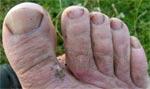 The small toes are much better. The big toe blister has reformed several times, and the dead skin is building up. August 7